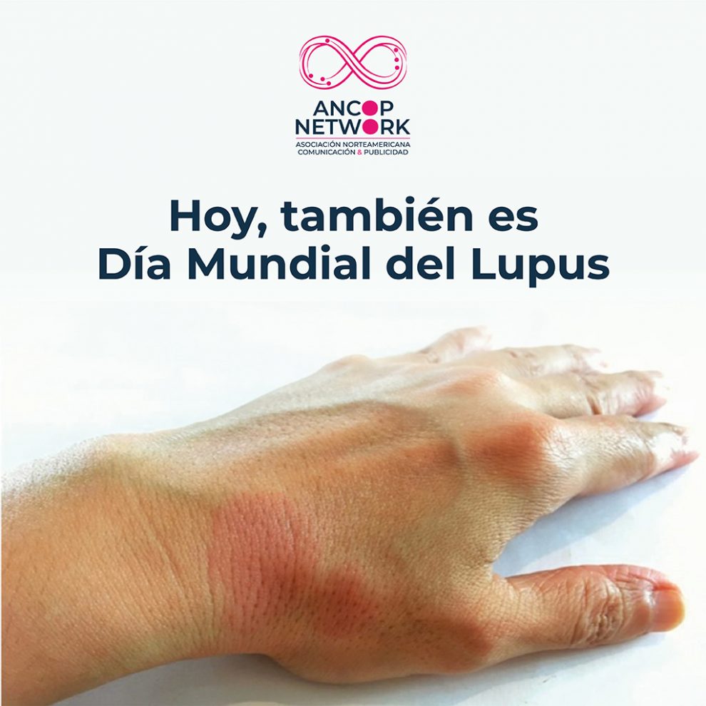 HOY, TAMBIÉN ES DÍA MUNDIAL DEL LUPUS 1 ANCOP 04 1