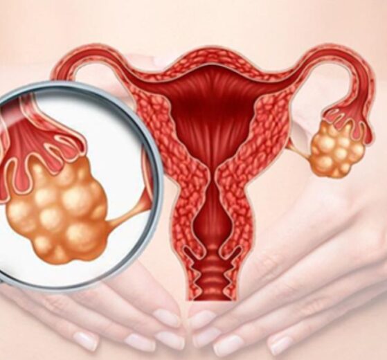 El síndrome de ovario poliquístico un desafío de salud en México