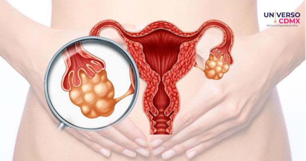 El síndrome de ovario poliquístico un desafío de salud en México