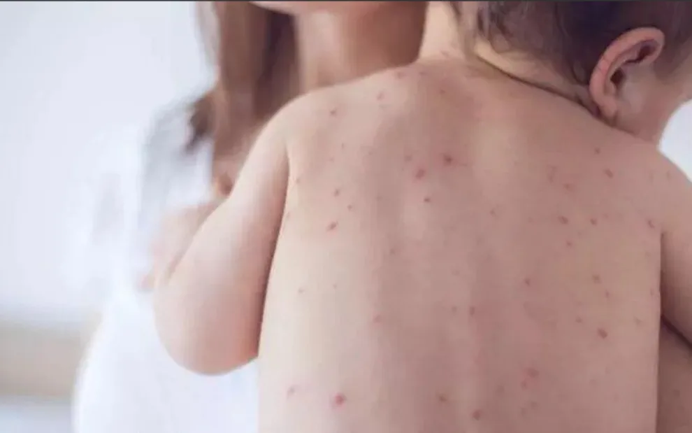 México registra 4 casos de sarampión asociados a contagio de importación