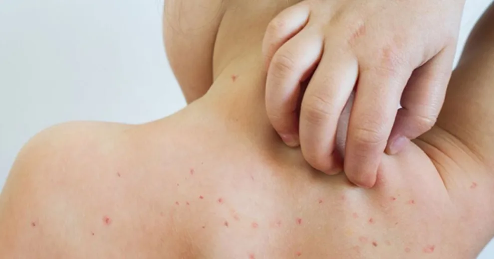 Redoblar esfuerzos en vacunación para prevenir contagios de sarampión, plantean en el Senado